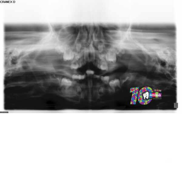 COPYRIGHT. NO USAR. Radiografía de un paciente en la clínica dental Dentikids donde se ve el apiñamiento por falta de espacio y que solucionamos con ortodoncia