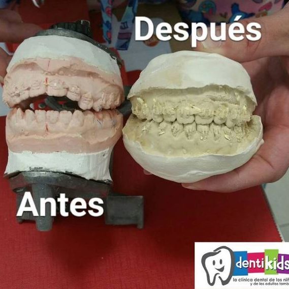 Caso real clínica dental Dentikids paciente deglución atípica dientes salidos solucionado con ortodoncia