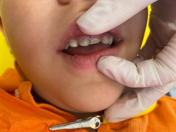 Niño, paciente en nuestra clínica dental Dentikids con mancha en los dientes que es defecto en el esmalte.