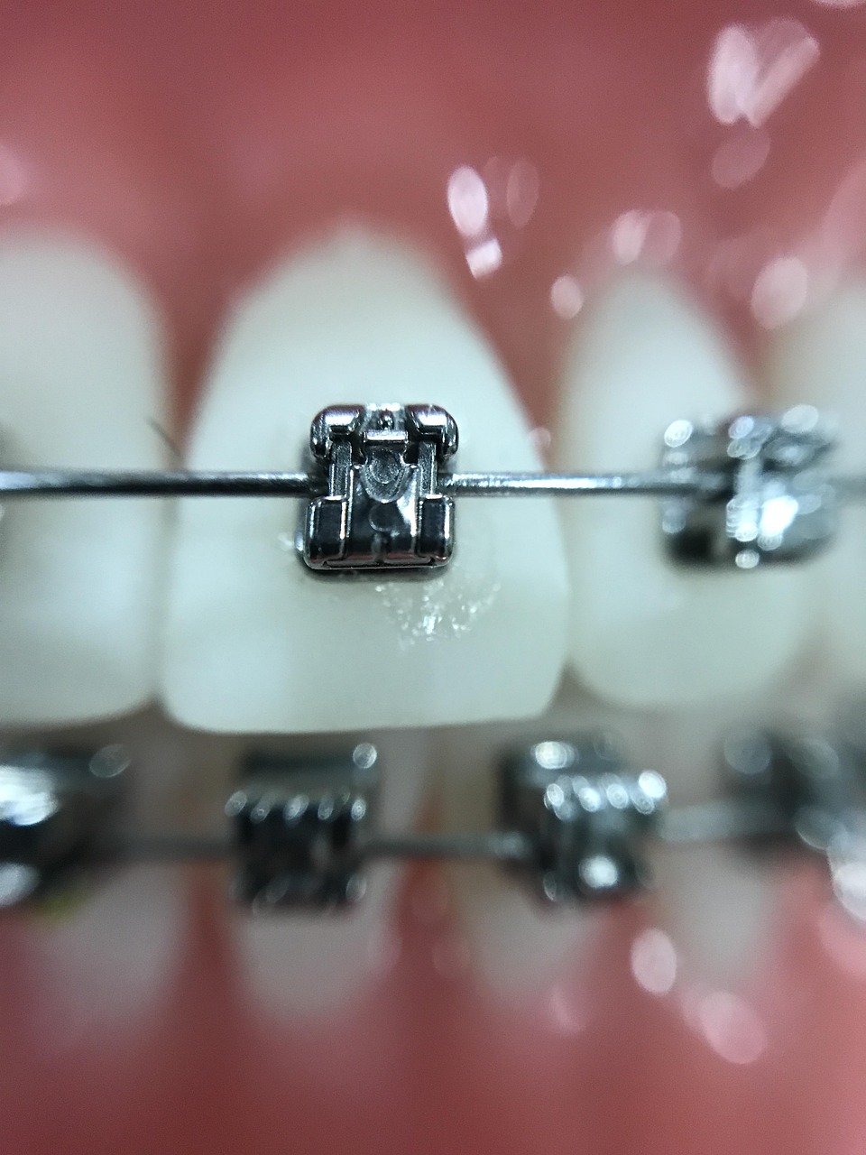 Zoom a un bracket que forma parte de la ortodoncia que permite tener dientes alineados.